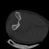 SPORK, NICO - 22.03.1976 - 02.08.2022 - CT obere Extremität - 17:51:17